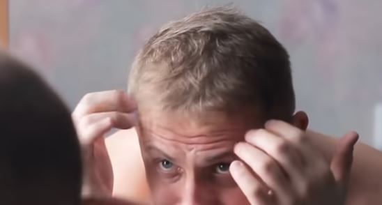 যে ভিটামিনের অভাবে চুল পড়া বেড়ে যায়