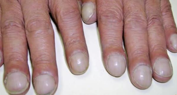 নখ দেখে নিশ্চিত রোগ নির্ণয় করা