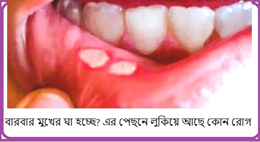 মুখের ঘা কেন হয়